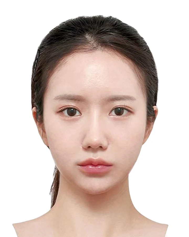 CASE 01 정면 수술 6개월 후