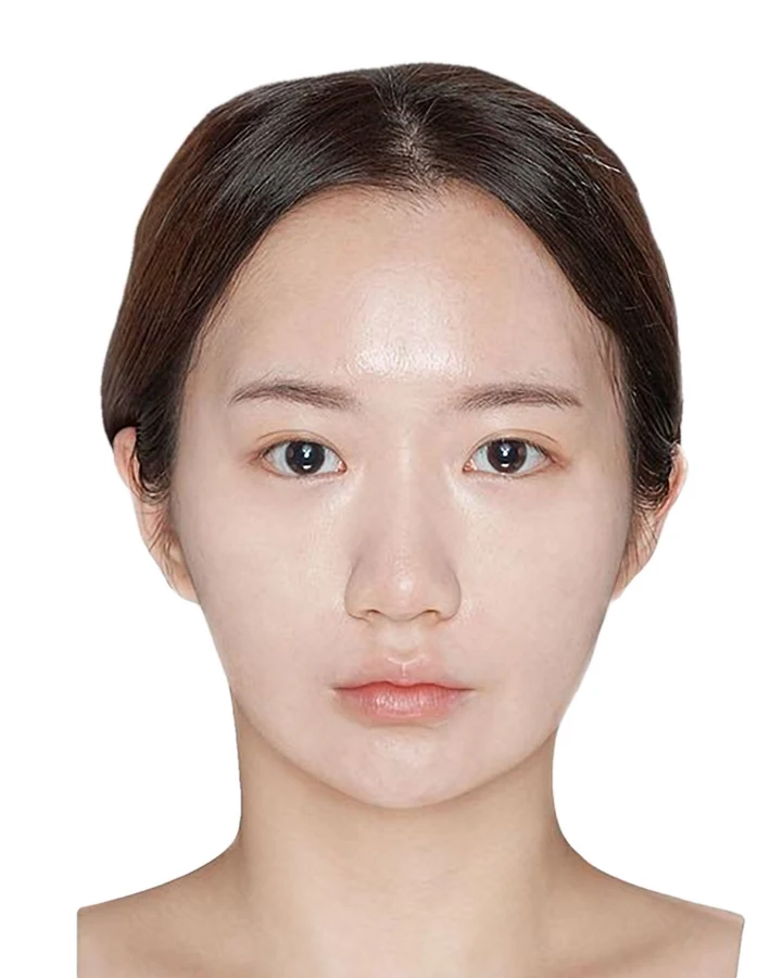 CASE 01 정면 수술 전