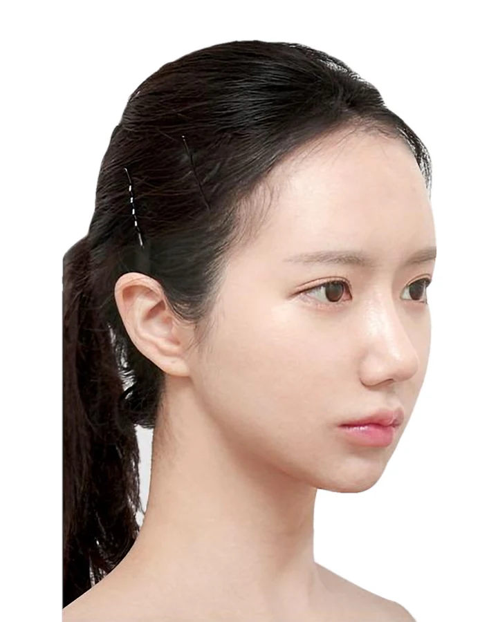 CASE 01 측면 수술 6개월 후