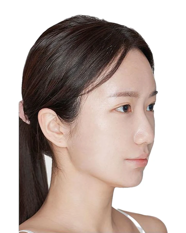 CASE 01 측면 수술 전