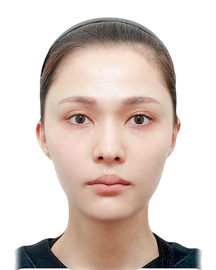 CASE 02 정면 수술 전