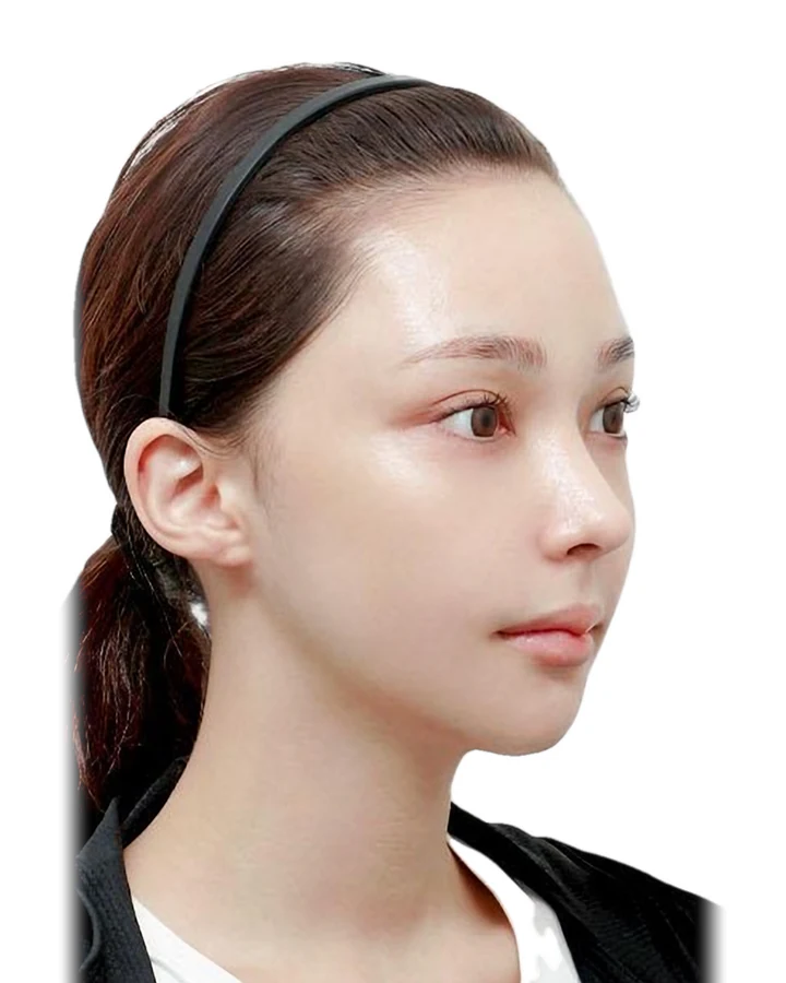 CASE 02 측면 수술 1개월 후