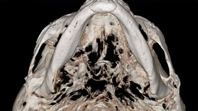 광대 축소 수술 6개월 후 3D-CT