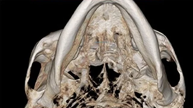 광대 축소 수술 전 3D-CT
