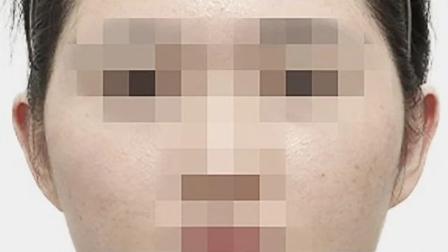 광대 축소 수술 전 정면