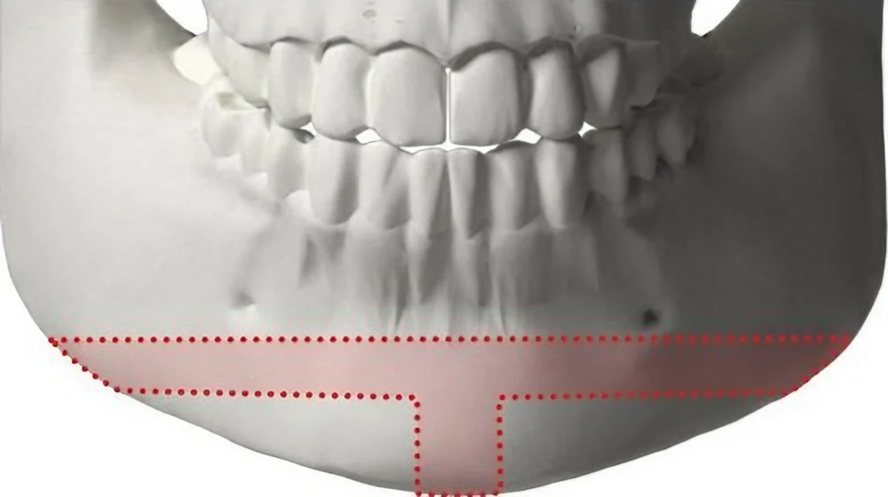 턱끝 절골 범위 3D 모형