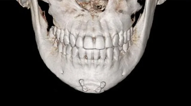 턱끝 수술 6개월 후 3D-CT