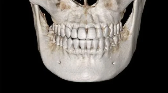턱끝 수술 전 3D-CT