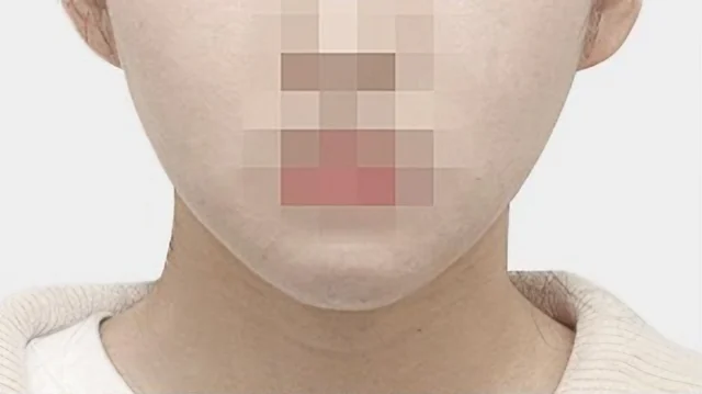 턱끝 수술 6개월 후 정면