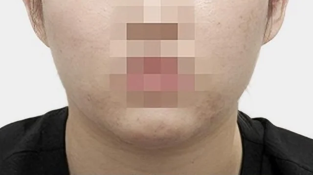 턱끝 수술 전 정면