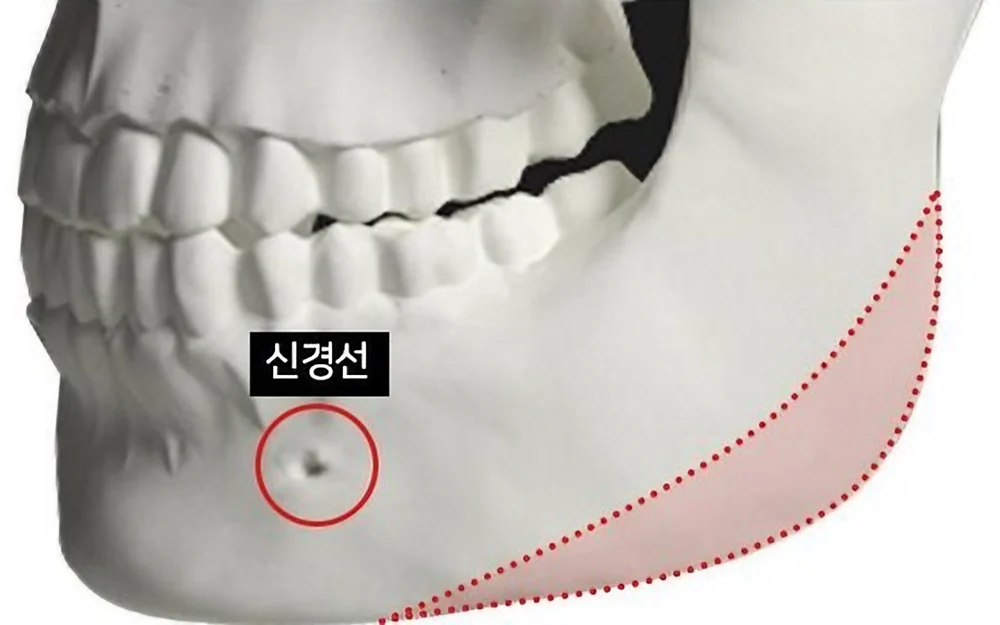사각턱 절제 범위와 신경선 위치