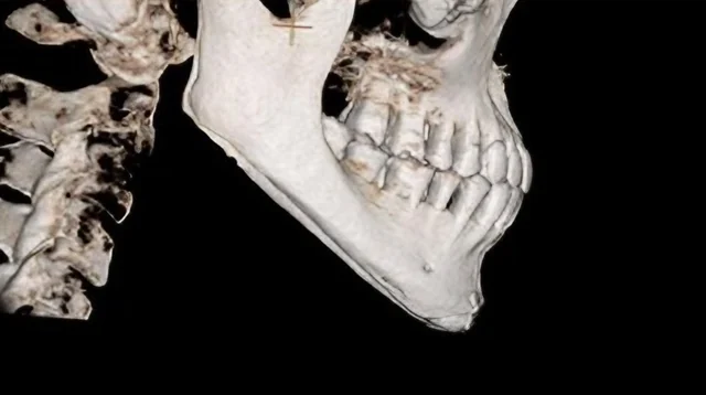 사각턱 축소 수술 6개월 후 3D-CT