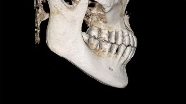 사각턱 축소 수술 전 3D-CT