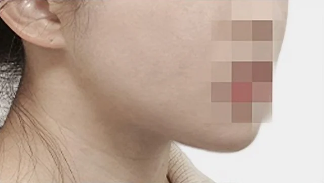 사각턱 축소 수술 6개월 후 측면