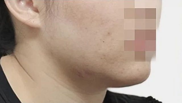 사각턱 축소 수술 전 측면