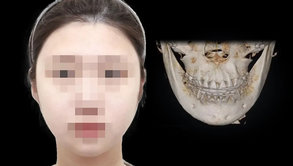 긴 얼굴 케이스 수술 1년 후 얼굴과 턱 부위 CT