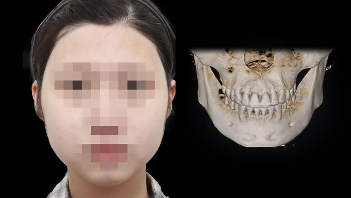 긴 얼굴 케이스 수술 전 얼굴과 턱 부위 CT