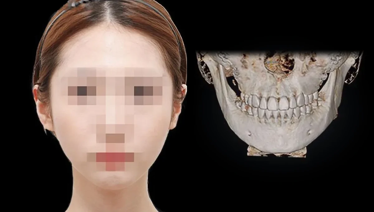 짧은 얼굴 케이스 수술 5개월 후 얼굴과 턱 부위 CT
