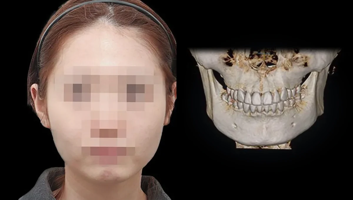 짧은 얼굴 케이스 수술 전 얼굴과 턱 부위 CT